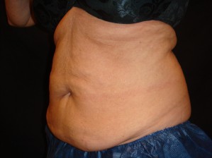 After: CoolSculpting abdomen. Significant reduction in excess adipose tissue